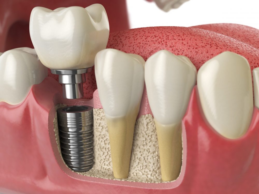 Cirurgia de implante