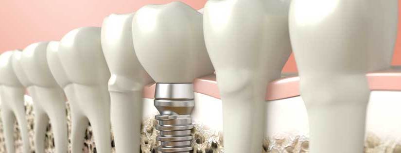 Cirurgia de implante