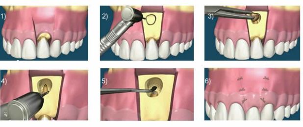 Cirurgia de implante